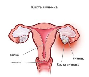 Киста влагалища: причины, симптомы и методы лечения